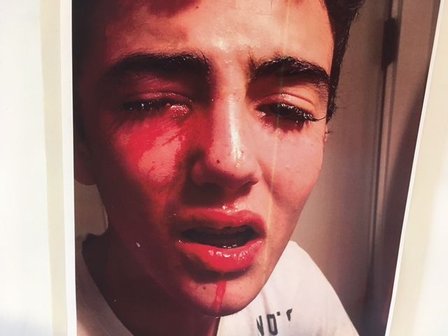 This is what North Van teen Matthys van Bylandt’s eye looked like after an egg hit him in the face.