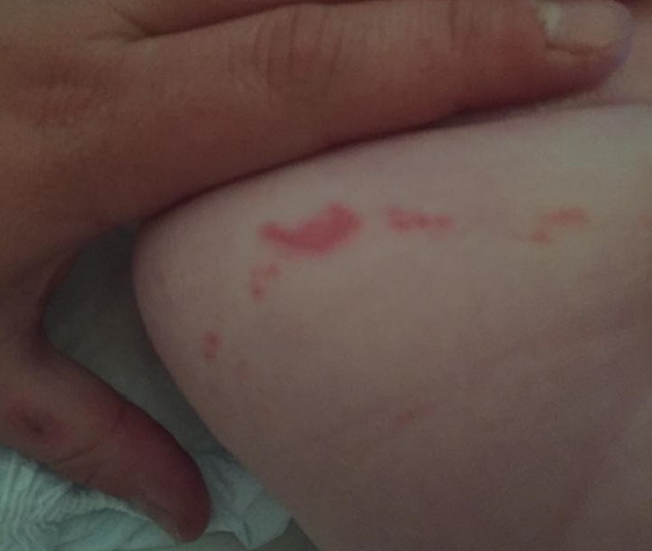 This photo was provided by Natalie, a Toronto mom who asked Global News to remain anonymous. The picture shows the skin irritation Natalie said she discovered on one of her baby daughters after switching to a new type of Pampers diapers.