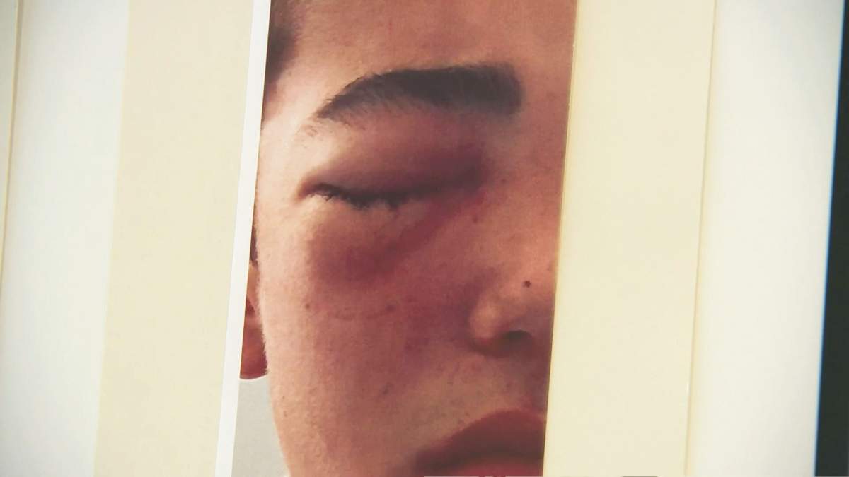 North Vancouver teen Matthys van Bylandt, after he was hit in the face with an egg on Monday, Aug. 21, 2017.