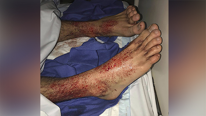 Sam Kanizay’s feet are seen covered in what looked like hundreds of bleeding little pin holes. A teenager who went for a swim at a Melbourne beach and emerged with his feet covered in blood has stumped marine experts.