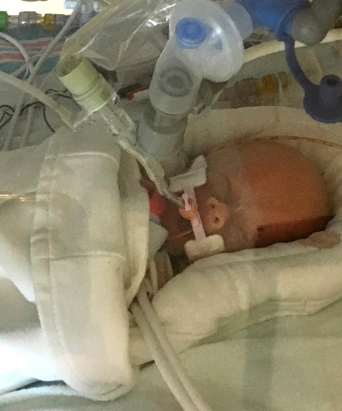 In this Sept. 8, 2017 file photo provided by Sonya Nelson, Life Lynn DeKlyen lies in the Neonatal Intensive Care Unit of the University of Michigan Hospital in Ann Arbor, Mich. 