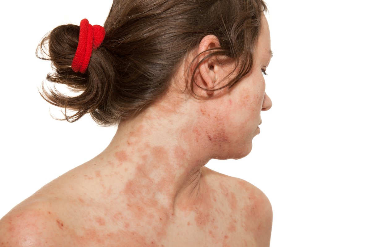 It's estimated that 17 per cent of Canadians suffer from eczema, the Canadian Dermatology Association says.
