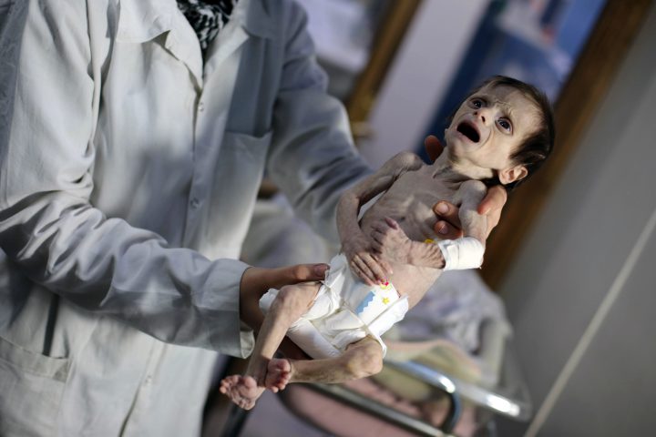 A Syrian infant suffering from severe malnutrition is carried by a nurse at a clinic in the rebel-controlled town of Hamouria, in the eastern Ghouta region on the outskirts of the capital Damascus, on Oct. 21, 2017.