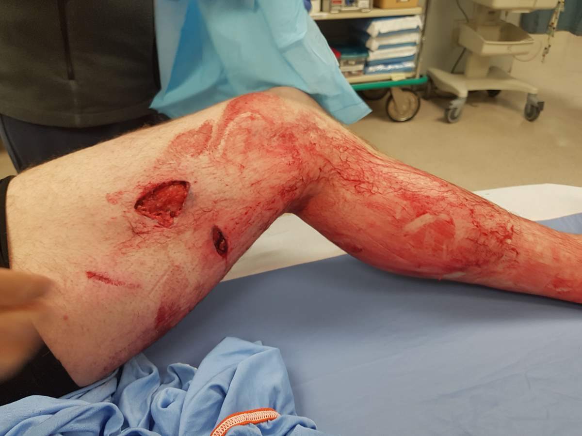 Jake Blackmore’s leg, after a grizzly bear bit him while on a hunting trip in the forests near Fernie, B.C.
