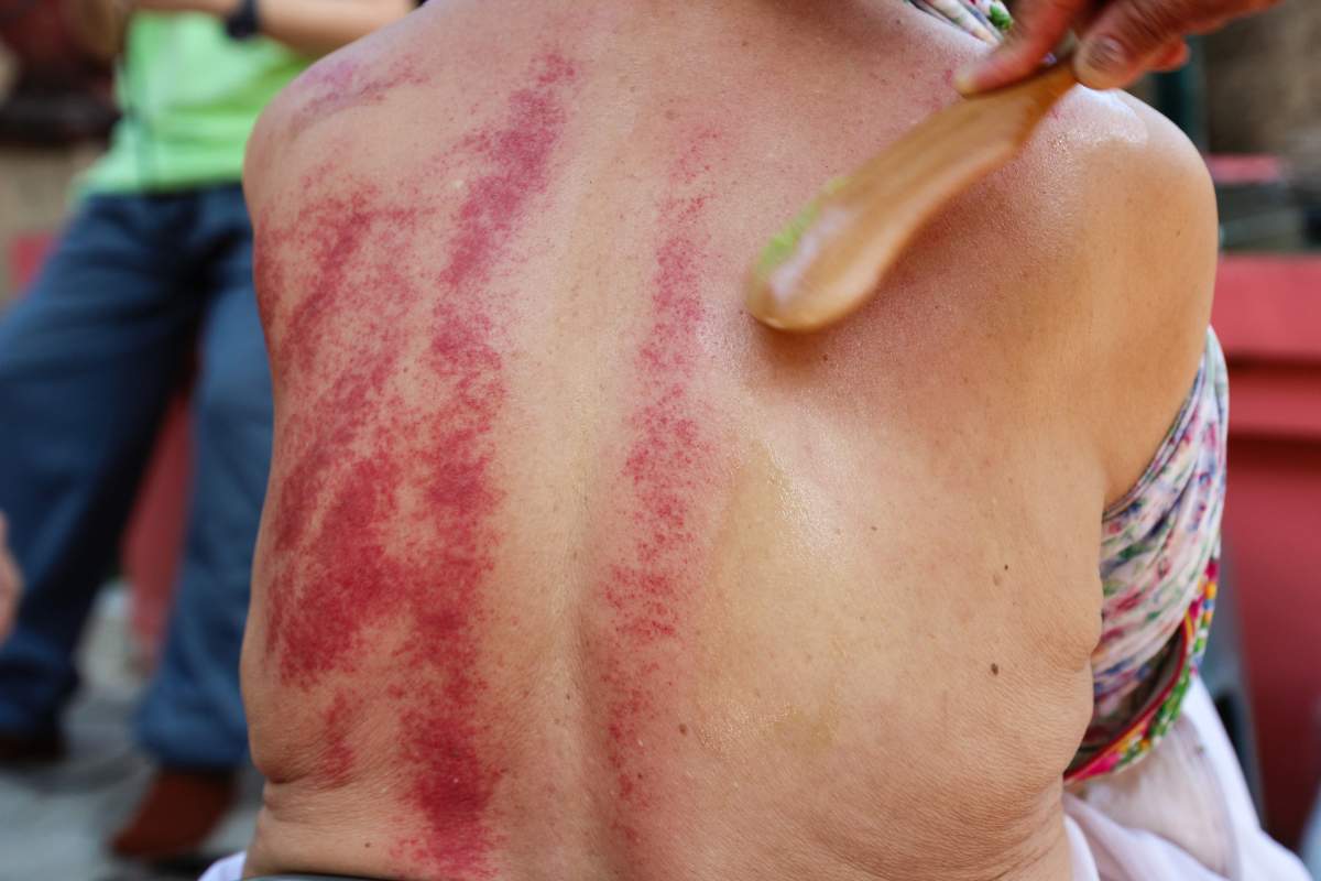 Gua Sha is an East Asian alternative medicine technique that claims to help relieve pain. 