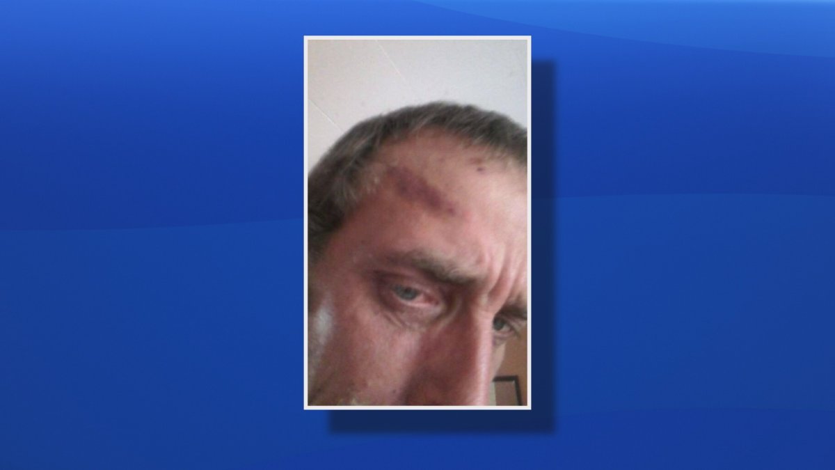 N.L. hunter suffers hoof-shaped bruise in brawl between man and moose - image