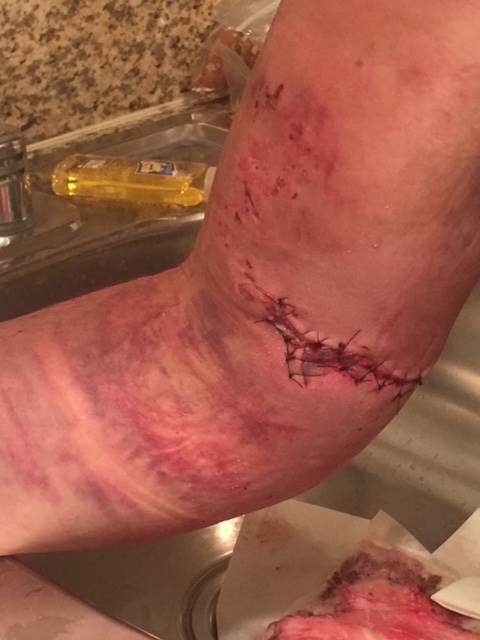 Martin Sorensen received 15 stitches just above his elbow after he was shot on Sunday.