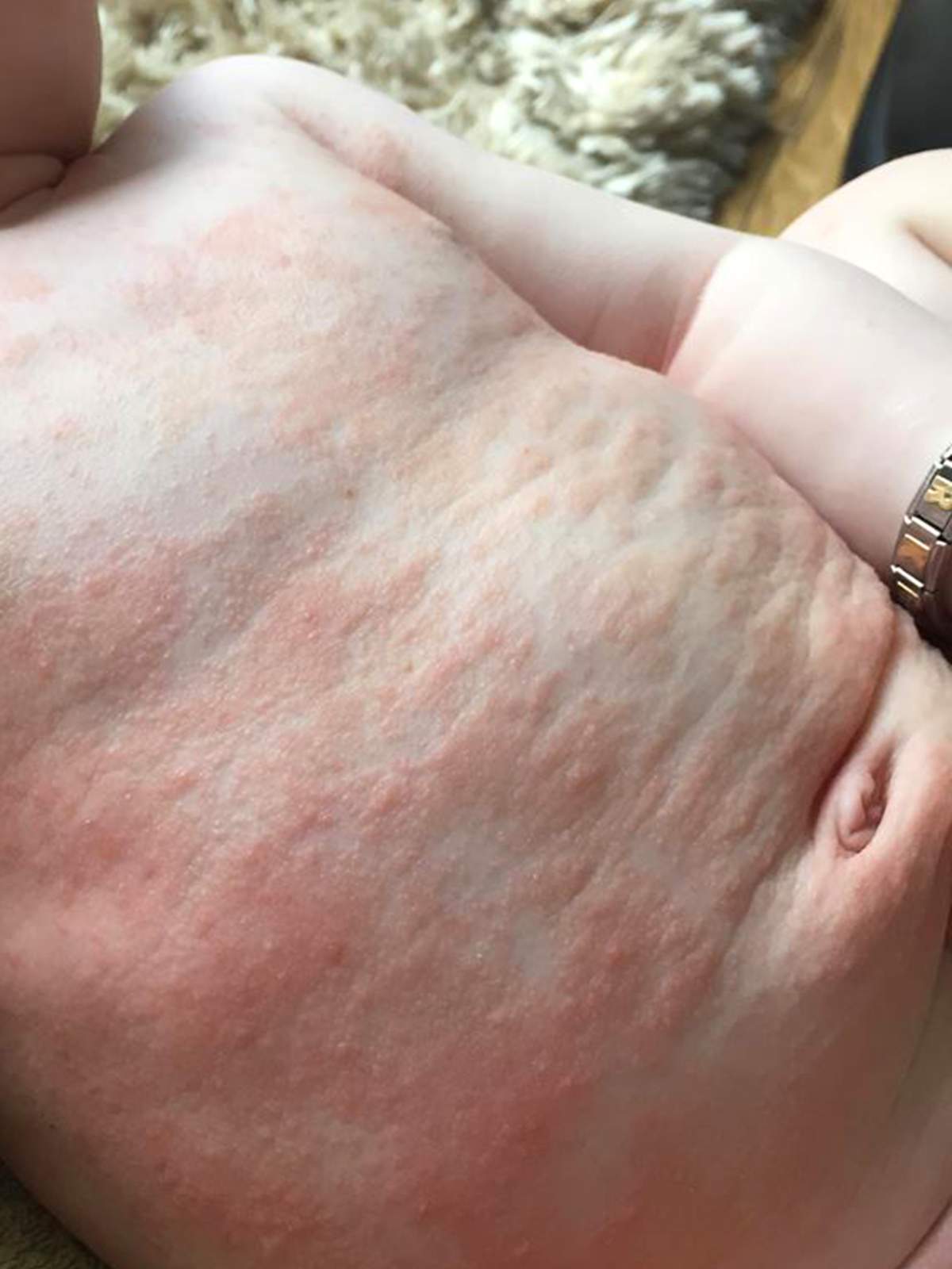 A toddler ‘almost died’ from contracting herpes from a kiss - image