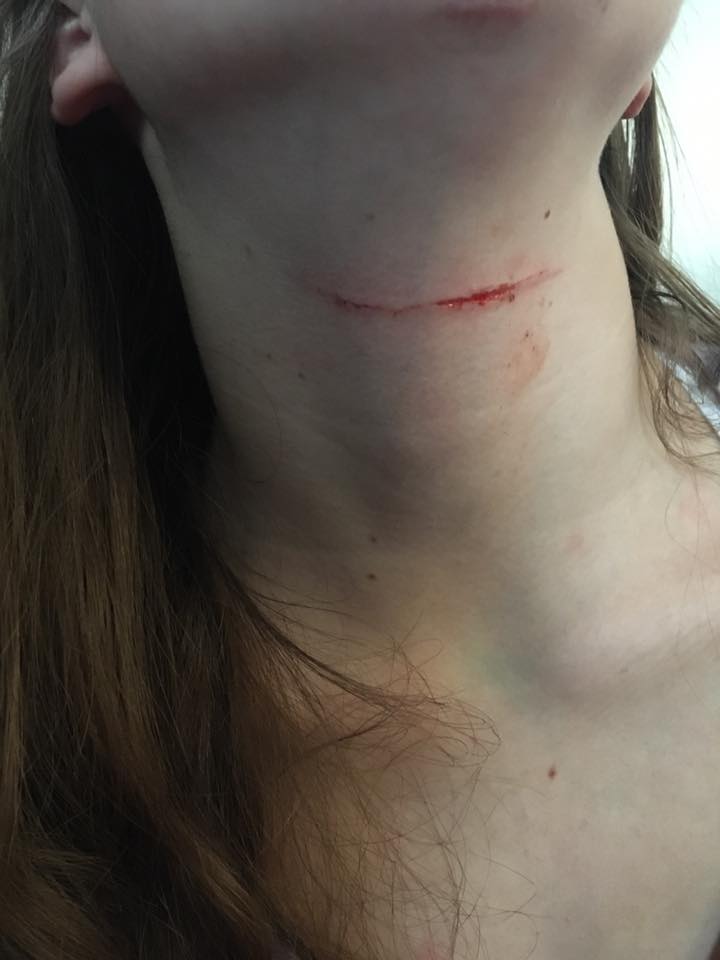 Teen girl suffers injury after attack in Okotoks.