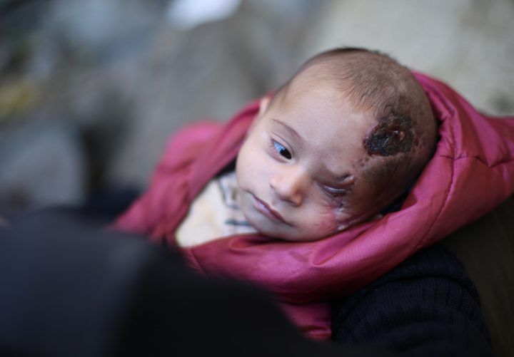 A Syrian baby, Karim, who lost his left eye and his mother after the Assad regime’s attack on Hammuriye district, is seen with wounds on his head in besieged Damascus suburb of Eastern Ghouta, Syria on Dec. 15, 2017.