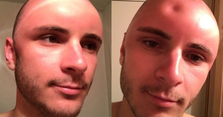 Man Can Put A Dent In His Head After Severe Swollen Sunburn National