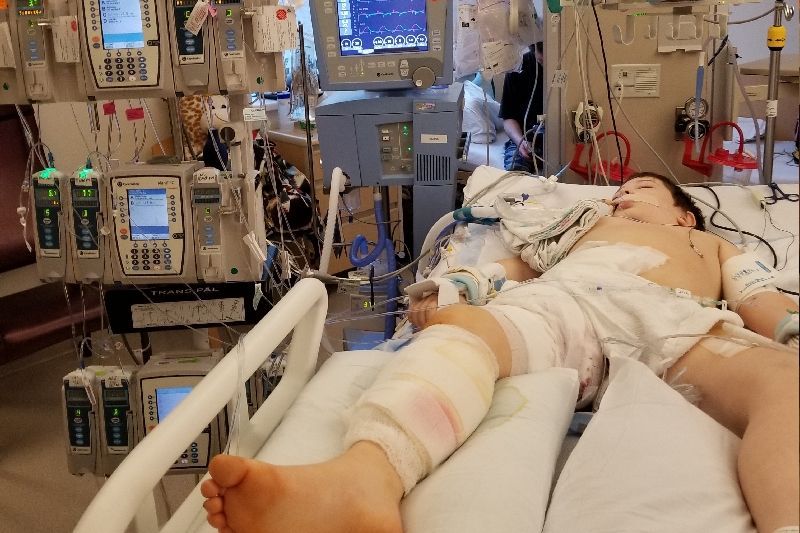 Liam Flanagan underwent a number of surgeries to try and remove the flesh-eating bacteria, which was spreading all over his body.