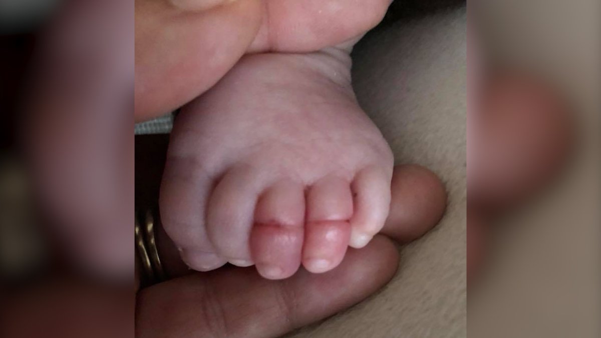 Heather Fricke's 10-week-old son suffered from blue toes after a piece of hair was tied around his toes. 