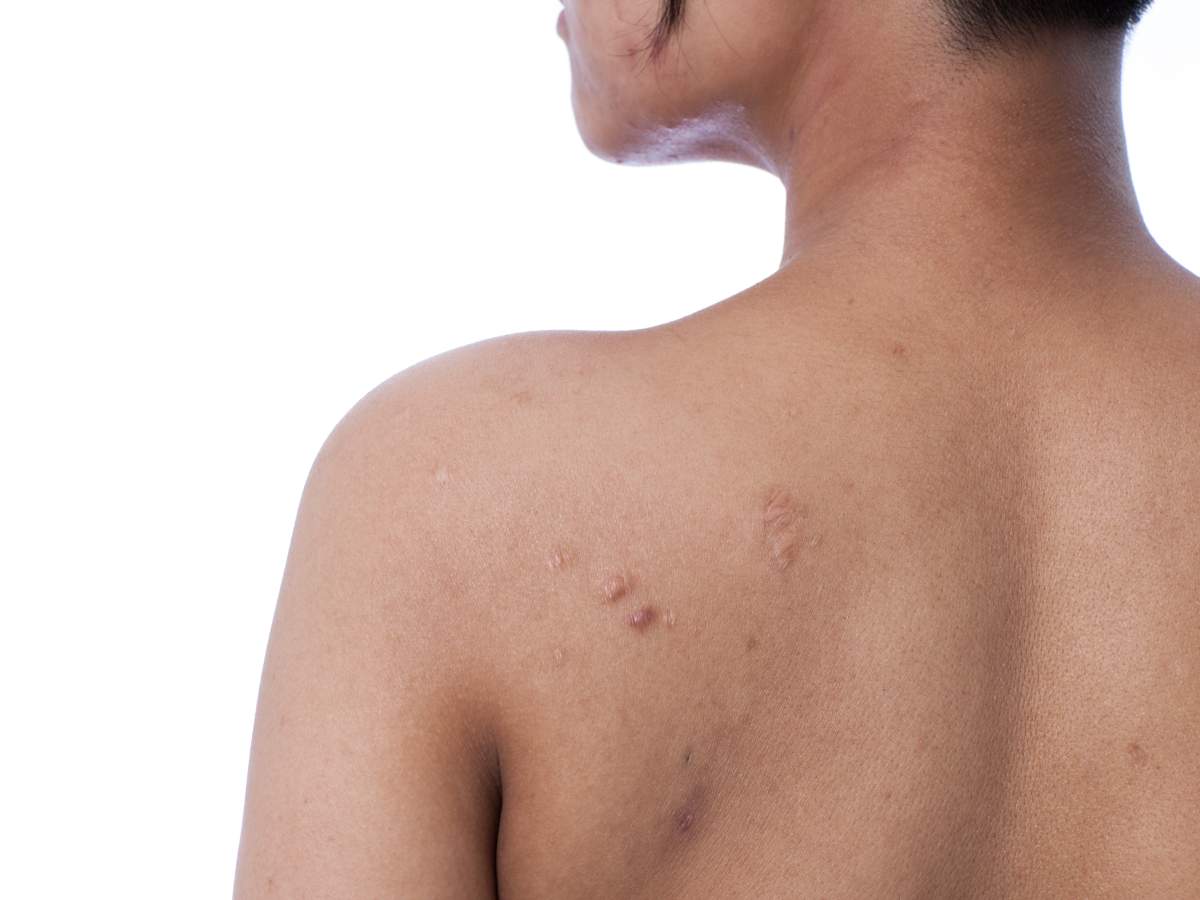 Bacne is a result of clogged pores on your back, and it can be stubborn and recurrent. 