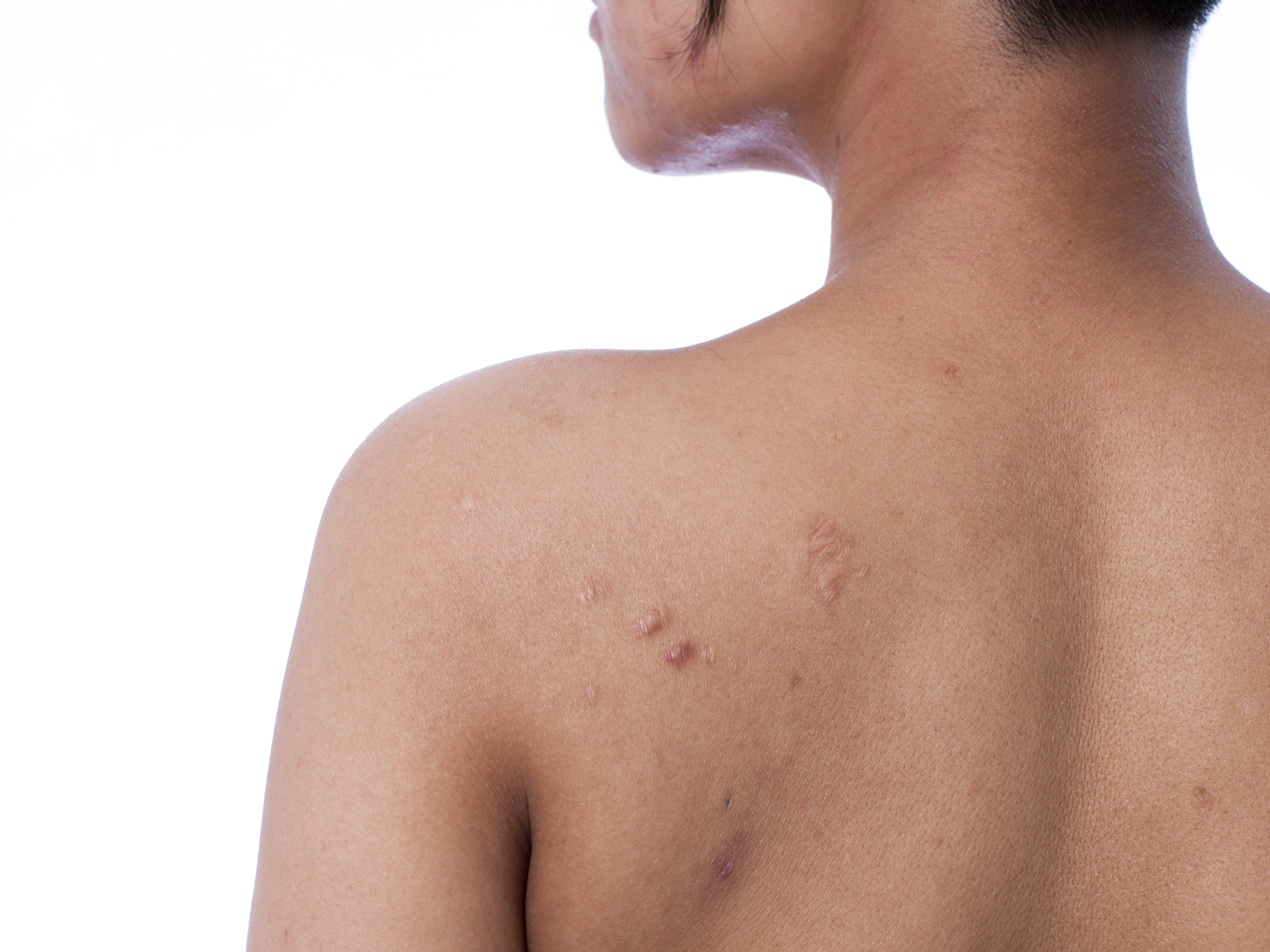 How to Get Rid of Back Acne:15 Best Tips for Bacne in 2024