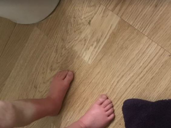 This Minnesota toddler is allergic to water — including her own sweat and tears - image