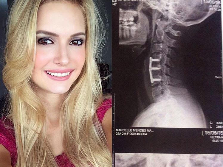 Marcelle Mancuso was paralyzed from the neck down for a month following her injury. 