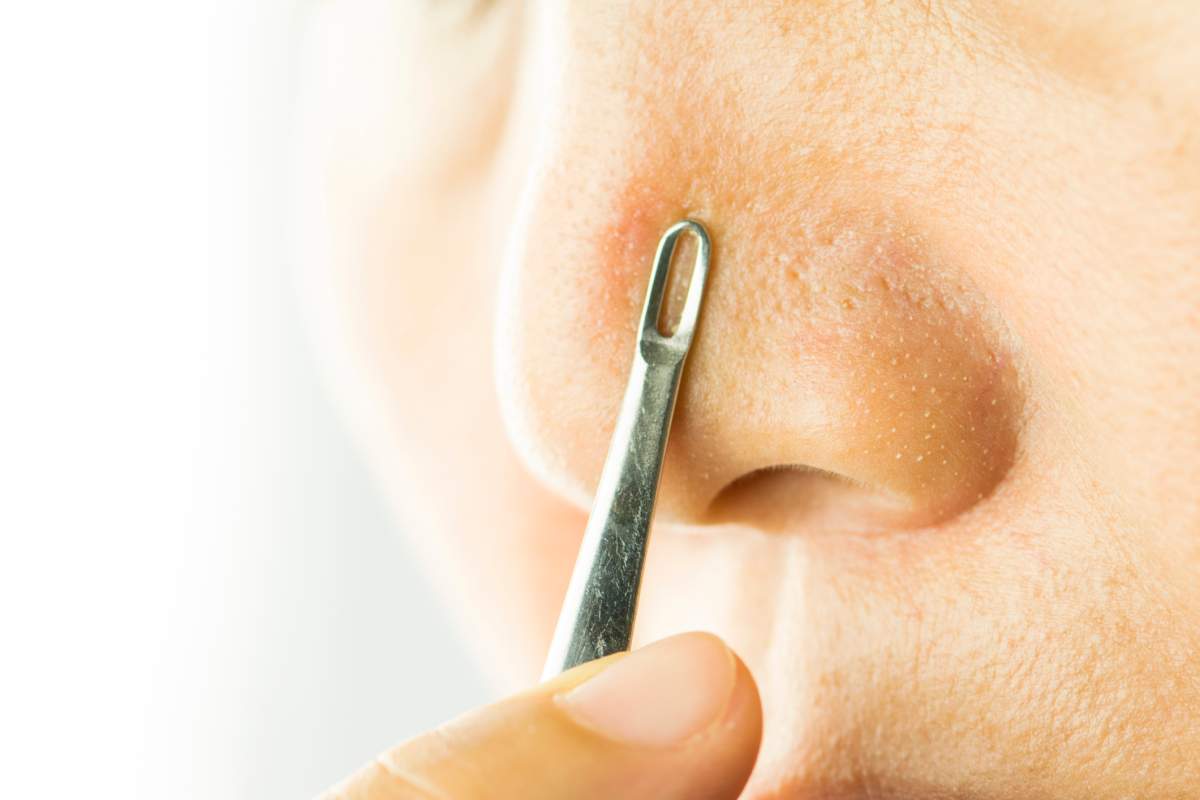 Blackheads dos and don’ts — how to fix this common skin problem - image