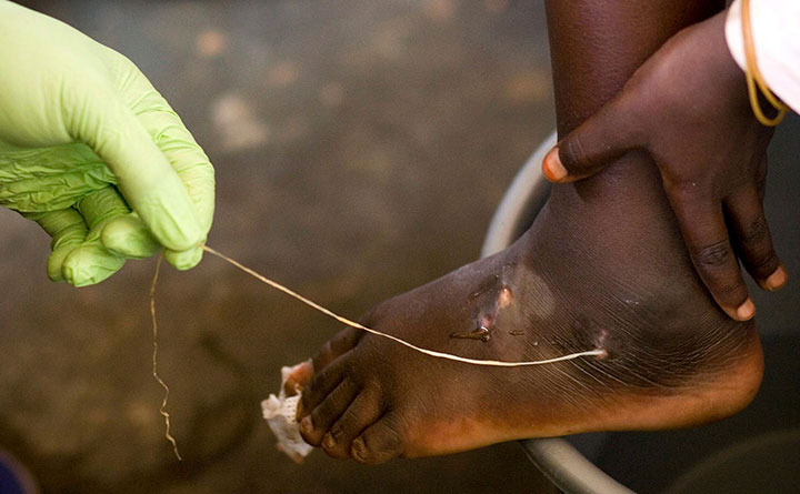 In this March 9, 2007 file photo, a guinea worm is extracted by a health worker from a child's foot at a containment centre in Savelugu, Ghana. 