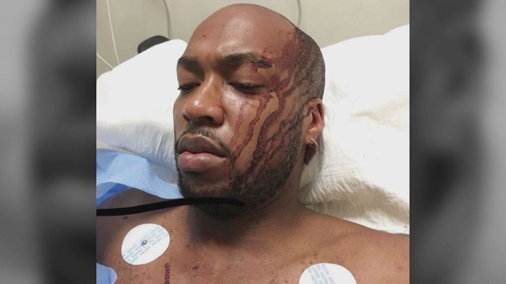 ‘I will never go to Mexico again’: Ontario man claims he was attacked, robbed in Playa Del Carmen - image