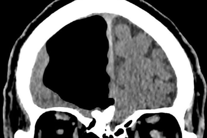 A scan of a man from Northern Ireland, showing a major cavity in his skull.