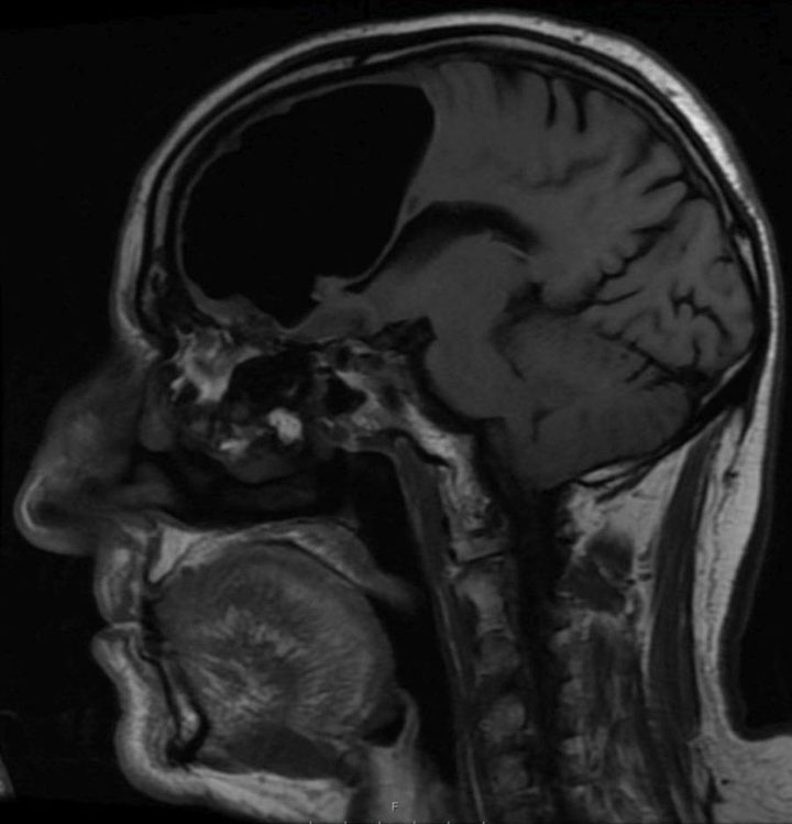 MRI showing the cavity in the man’s skull.