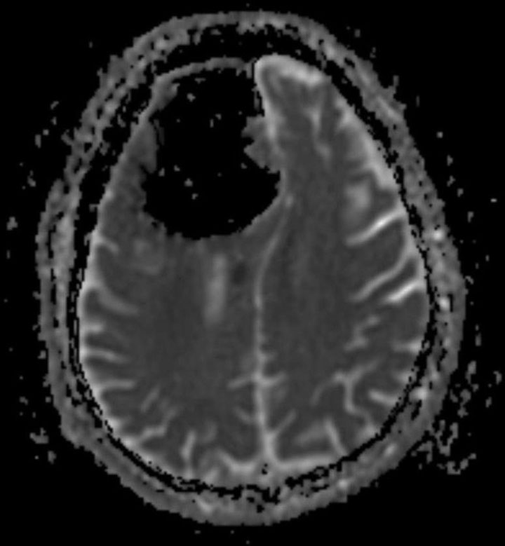 MRI showing area of acute infarction, or stroke.