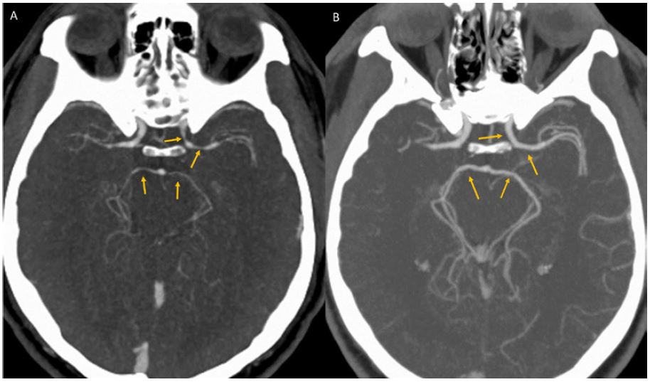 A scan of the man’s brain showing constricted arteries on the left. On the right is the same man’s brain five weeks later, with larger arteries.