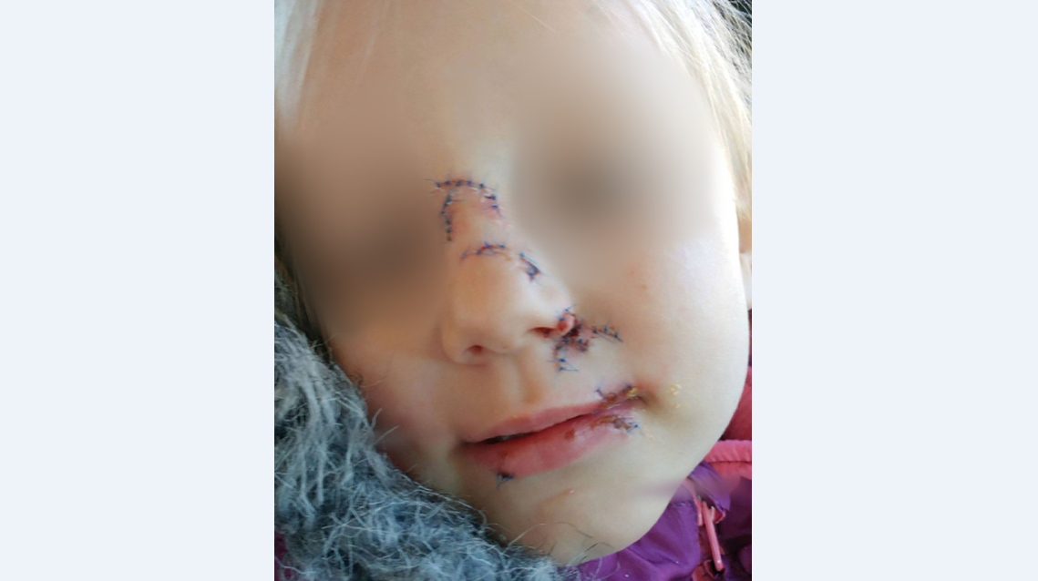 Kayla Ward's three-year-old girl was bit twice in the face by a dog. She had to get at least 59 stitches in her face.
