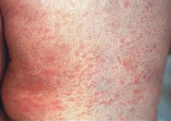 Public Health issue warning after case of measles confirmed in Halifax area