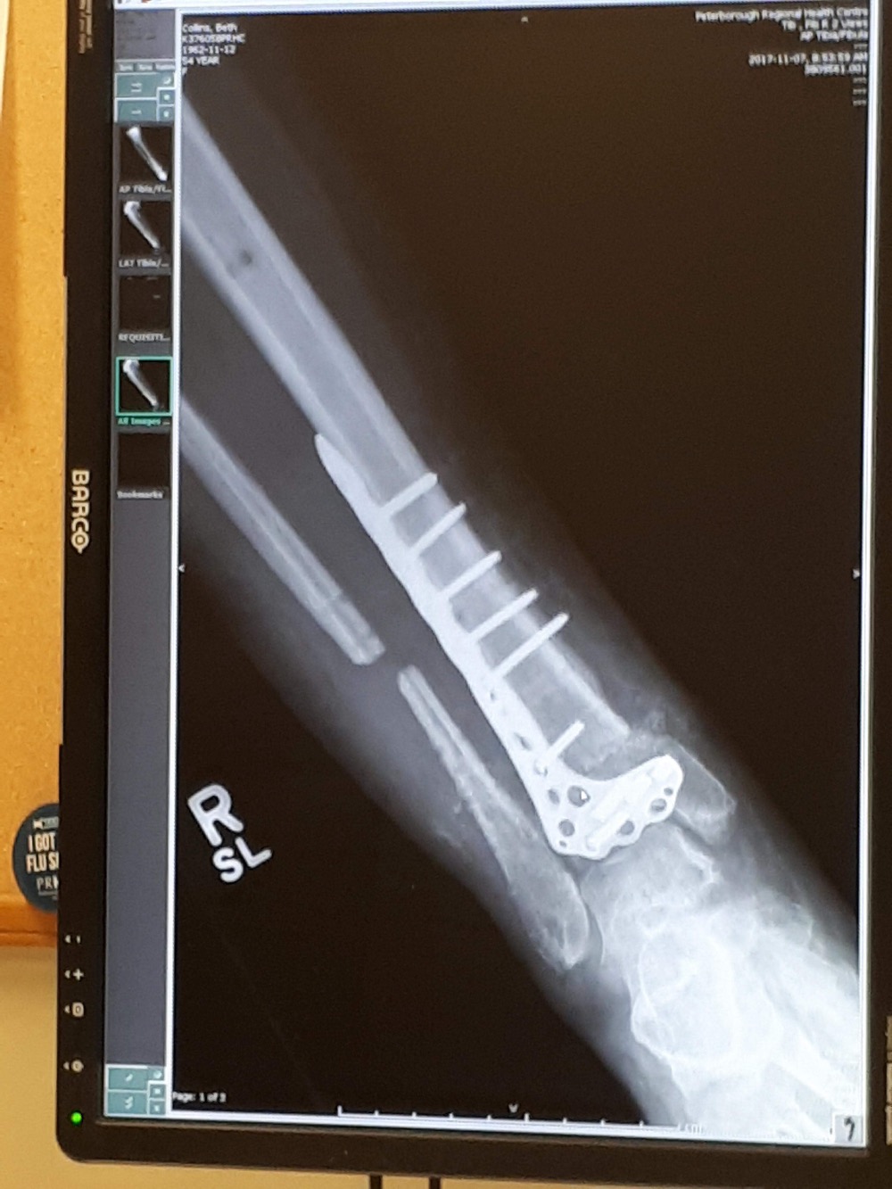 An x-ray of Beth Collins’ leg.