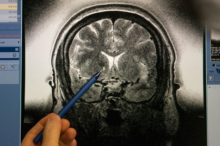 A researcher points to a brain lesion created through the ultrasound procedure.