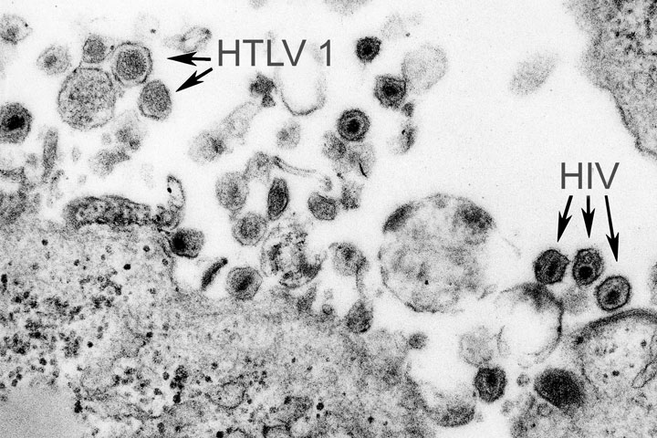 Presence of both the human T-cell leukemia type-1 virus (HTLV-1) and the human immunodeficiency virus (HIV) revealed in the transmission electron microscopic (TEM) image, 1980. Image courtesy Centers for Disease Control (CDC).