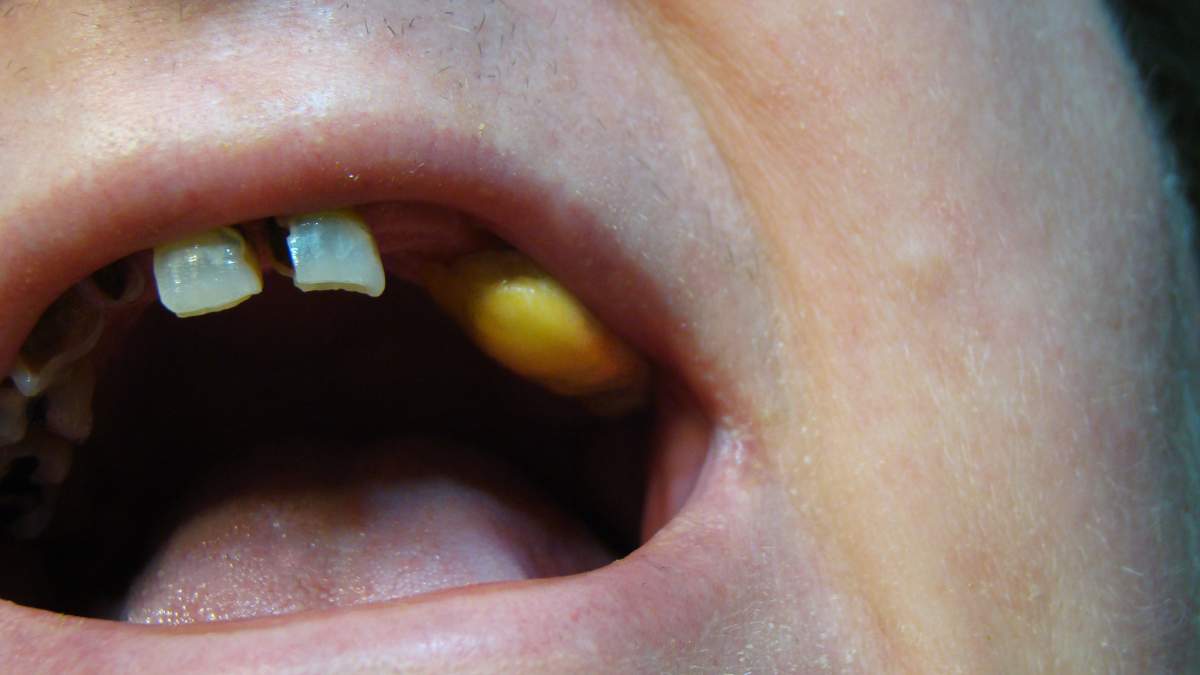 A picture of Brandi Jasmine’s teeth before surgery. “It shows a plastic cap I made myself to cover a broken tooth I could not afford to fix.” (Supplied)