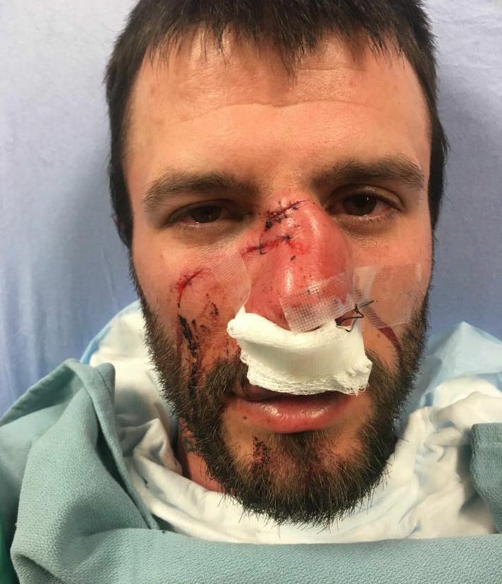 Kelly Scott had his face shattered while trying to halt a fight in Peterborough early Saturday morning.