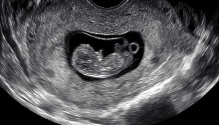 An ultrasound photo of a nine-week-old fetus in its surrogate’s womb. The baby’s intended parents travelled from Alberta to Ontario to attend the ultrasound with their surrogate.