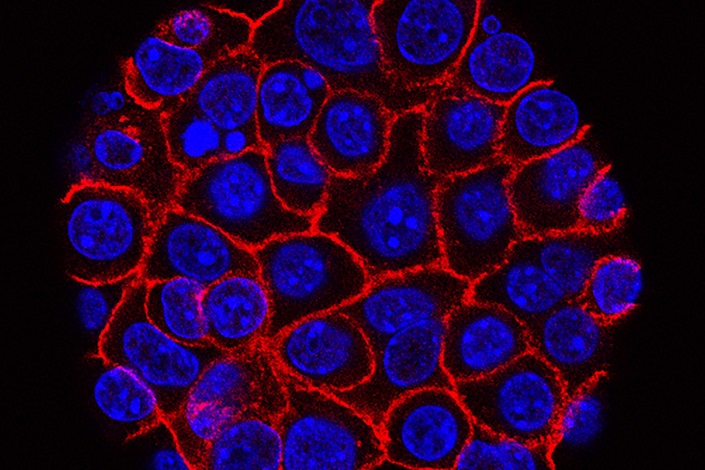 In a rare triumph for tough-to-beat pancreatic cancer, patients who had surgery lived substantially longer on a four-drug combo than on a standard cancer drug, according to research released on Monday, June 4, 2018. 