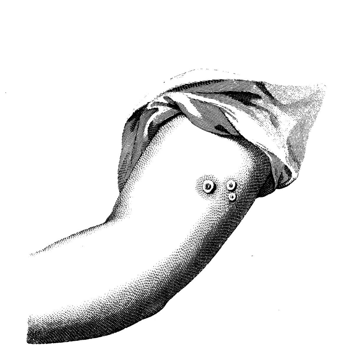 U.K. teen catches cowpox, a common 18th century disease - image