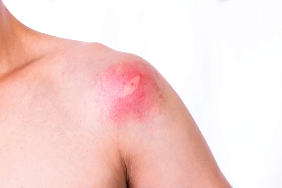 7 types of bug bites Canadians can expect this summer - image