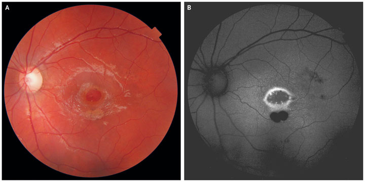 Scans of a boy's eye, showing a macular hole near the centre of Panel A, and two spots of associated eye damage in Panel B.