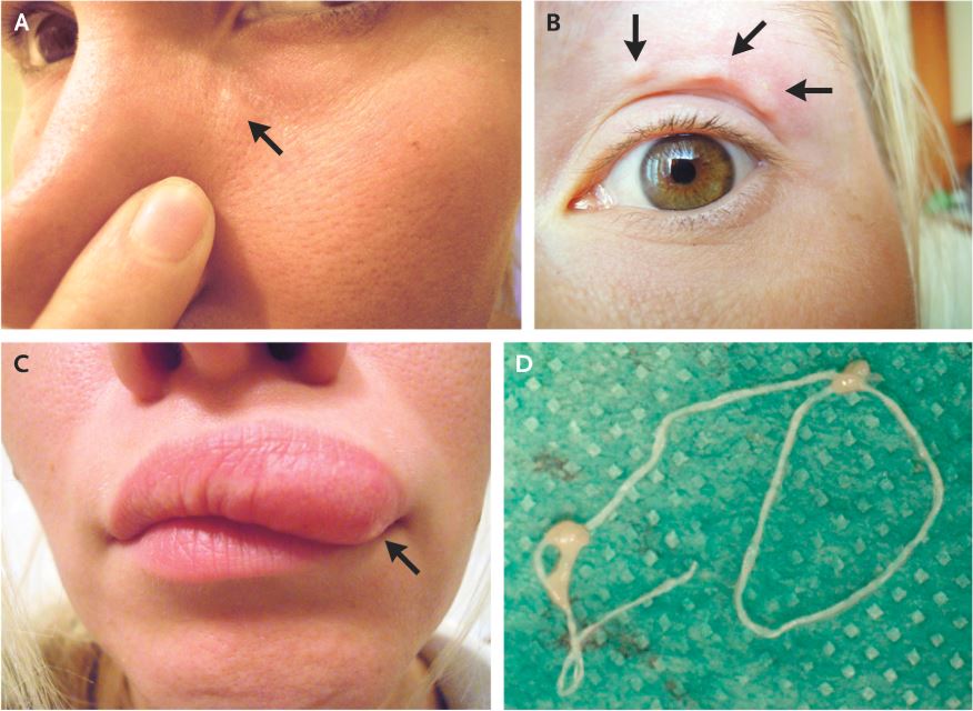 A series of photos showing the worm migrating around the woman’s face, and after it was removed.