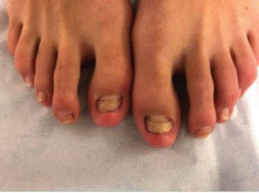 An image showing the woman’s toenails disappearing. 