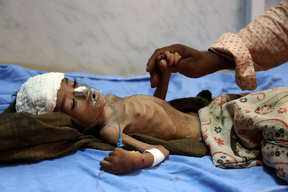 A malnourished Yemeni child awaits treatment at a hospital in the Yemeni port city of Hodeidah, May 7, 2018.
