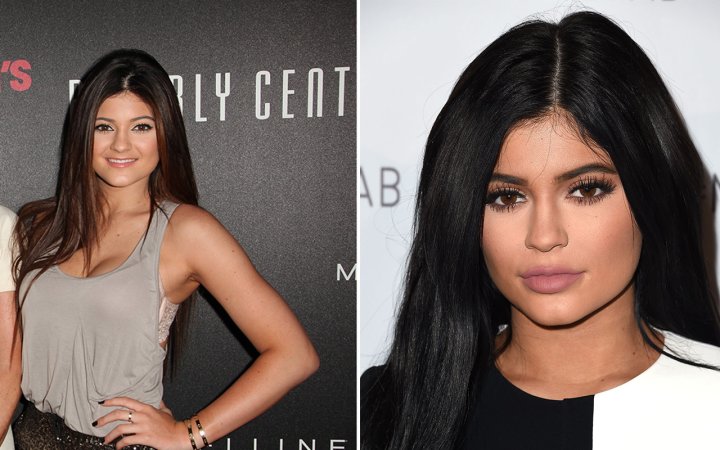 Kylie Jenner Says Shes Removed All Fillers From Her Lips National