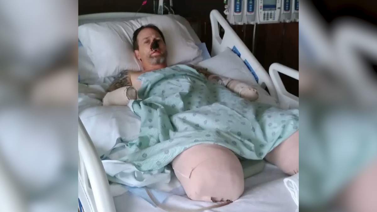 In this Aug. 2, 2018 file photo provided by Dawn Manteufel, Greg Manteufel lays in his hospital bed at Froedtert Hospital in Milwaukee. He lost parts of his arms and legs, as well as the skin of his nose and part of his upper lip from capnocytophaga.