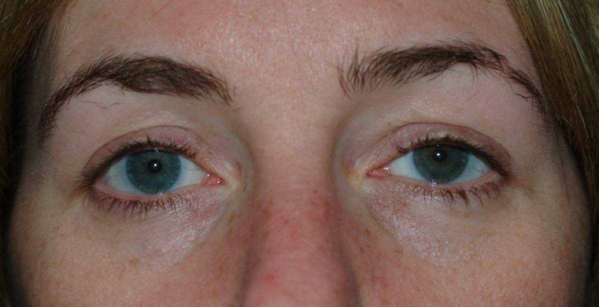 A photo of the woman’s eyes, showing a very slight droop (or ptosis) of her left eyelid.