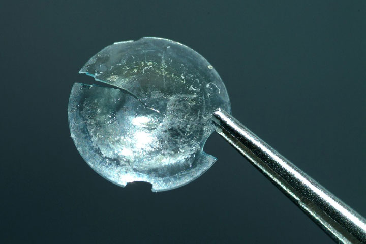 A 28-year-old hard contact lens was pulled out of a woman's eyelid. Doctors say it was largely intact in her eye, but cracked as they removed it.