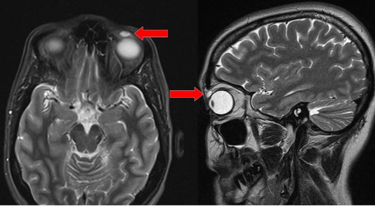 MRI scan of the woman’s head, with arrows pointing to the cyst above her eye.