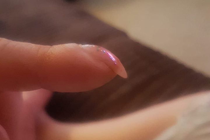 . woman's curved nail post prompts lung cancer diagnosis - National |  
