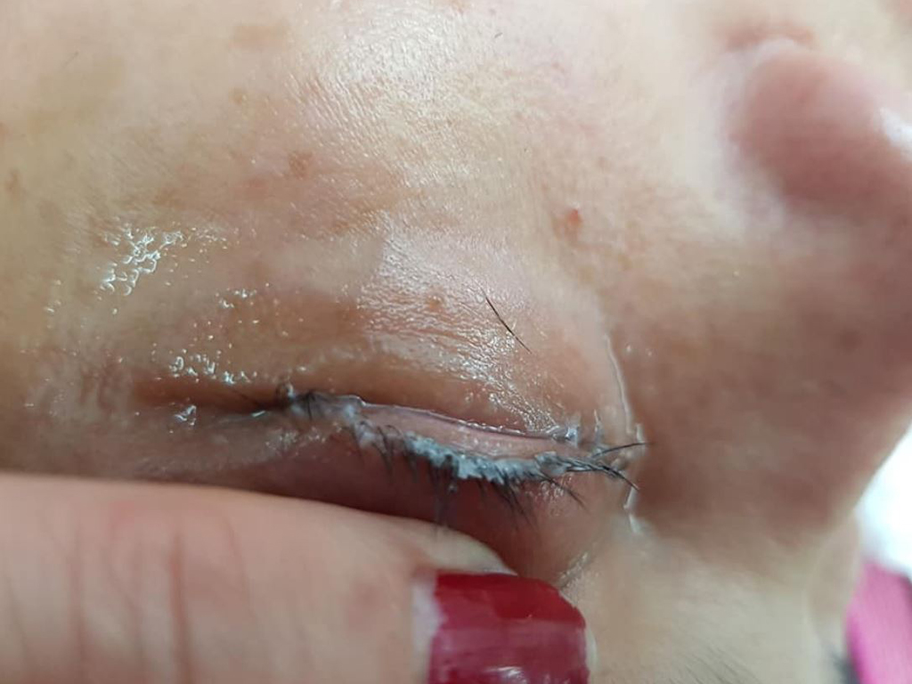 The removal process left the woman with sparse eyelashes and swollen lids.